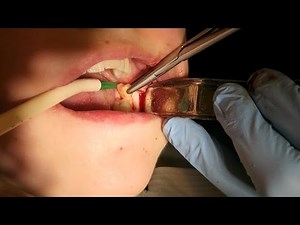 Surgical Extraction Of Wisdom Tooth • Video • MEDtube.net