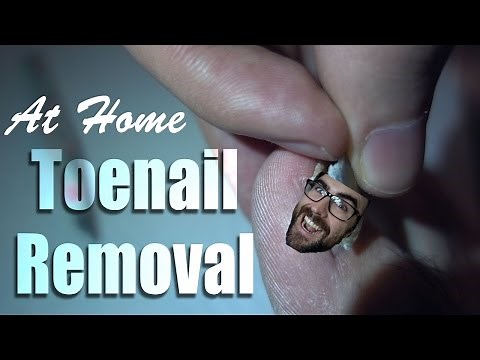 How To Remove a Toenail