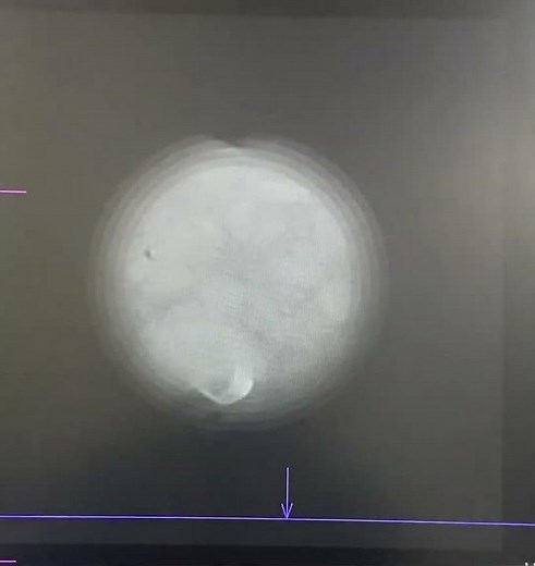 PEG tube insertion for cancer patients (for feeding purpose to the patients with oral cavity cancer)