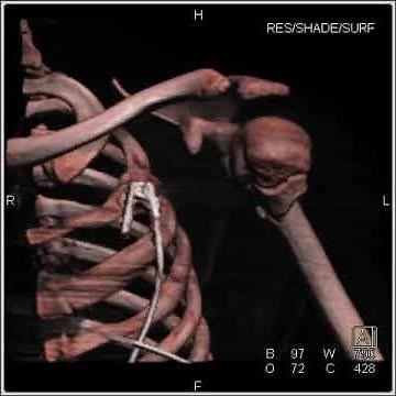 Musculoskeletal: Humerus fracture with various renderings