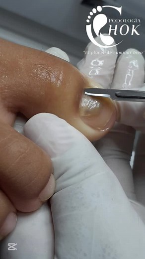 Proceso de extracción total de uña 🦶✨ La salud de tus pies es nuestra prioridad. ¡No descuides tus uñas, consúltanos a tiempo! ✅ haz tu reserva ahora al número:72649058 #Podología #SaludDeTusPies #CuidadoPersonal#paratiiiiiiiiiiiiiiiiiiiiiiiiiiiiiii #viral #sczbolivia🇳🇬🇧🇴 #uñas #smr #satisfyingvideo