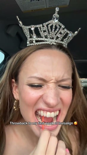 How first week of Invisalign feel like?