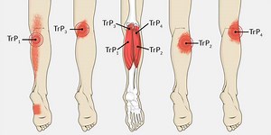 Restless Leg Syndrome Effective, Natural Therapy