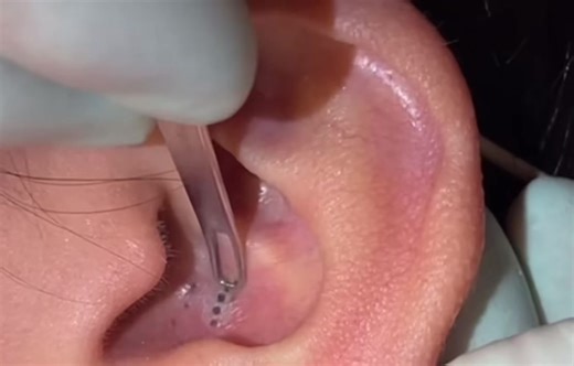 Professional Ear Piercing Techniques Explained