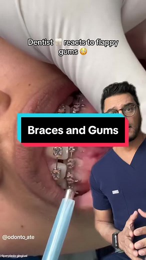 Don't Let Braces and Gums Cause Concern | Dental Tips