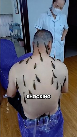Why Doctors Still Use Leeches in Modern Medicine #shorts
