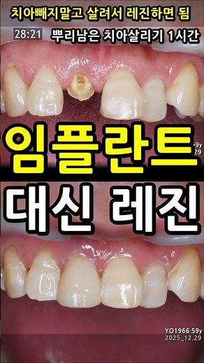 임플란트 대신 레진. 부러진치아 1시간내로 크라운없이 신경치료MTA하고 기둥레진으로 살리기 2026_01_02 #치아살리기1시간쇼