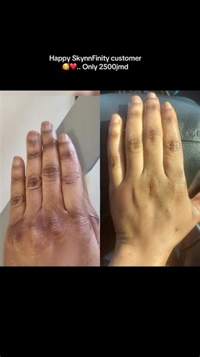 Achieve Clear Skin with SkynnFinity Booster Cream