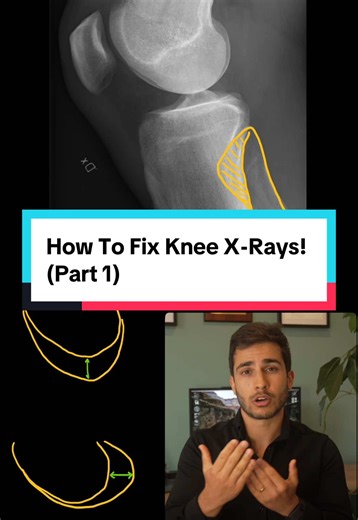 If you’ve ever needed to repeat a Knee X-ray, which almost every single one of you, then this should help. It’s about the int vs ext rotation of the knee and how much tube angle is required to get it perfect every time. #radiography #xray #medicalimaging #knee #positioning