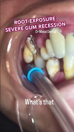 TOOTH ROOT EXPOSURE