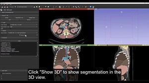 Automatic whole-body CT segmentation in using 3D Slicer and TotalSegmentator