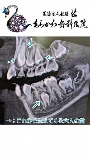 大人の歯はどこにあるの??生え変わりをCTで見てみた！ #あらかわ歯科医院