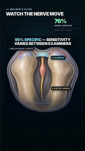 The Click That Exposes Morton's Neuroma #Shorts