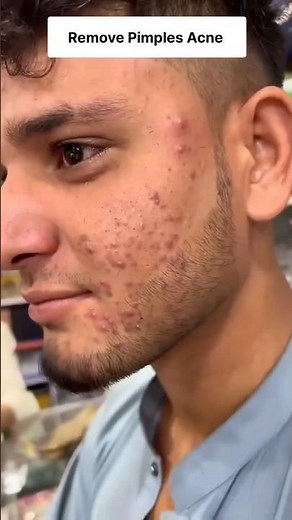 Remove Pimple Acne Naturally At Home | Get Clear Spotless Skin ✨ Pimple Removal Tips #ytshorts