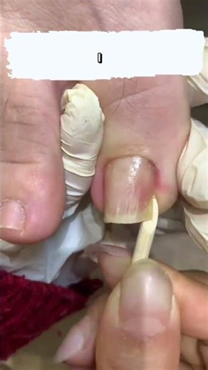 The Right Way Cleaning Toenails (Begginers Friendly)