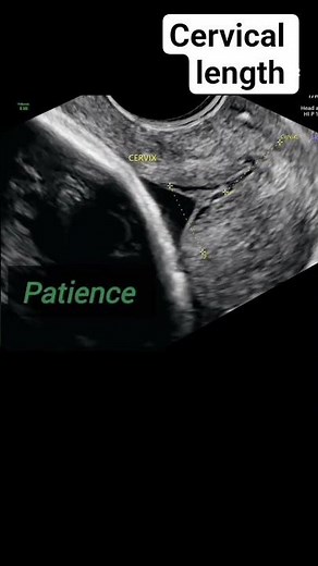Cervical length on ultrasound #radiology #pregnant #ultrasound #pregnancyscan #baby