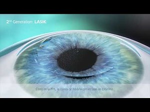 Cirugía refractiva - PRK FEMTO LASIK y SMILE - Clínica Tecnoláser