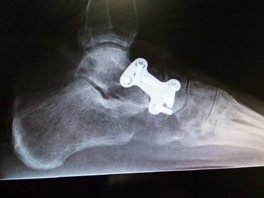 Life After Talonavicular Fusion: What You Should Know