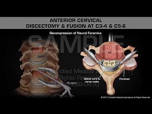 Anterior Cervical Discectomy & Fusion at C3-4 & C5-6