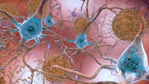 New Alzheimer’s drug could signal potential treatment breakthrough