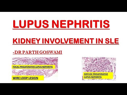 Lupus Nephritis | Wire Loop Lesion