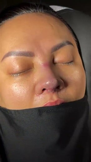 Rhinoplastie (opération du nez) avant-après en Turquie | Op. Dr. Yunus Kaplan