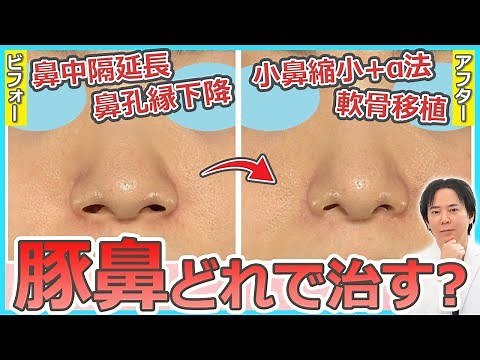 【鼻整形】豚鼻を治すにはどの美容整形を受けるべき？【鼻中隔延長・鼻孔縁下降・軟骨移植・小鼻縮小＋α法】