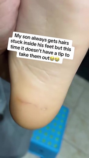 2.3K views |  It looked small, but wait till you see the ending! #drpimplepopper #grossaddiction | Reels For You | Facebook