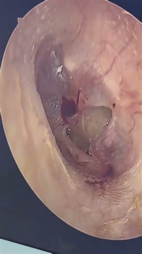 Traumatic Perforation of the Eardrum