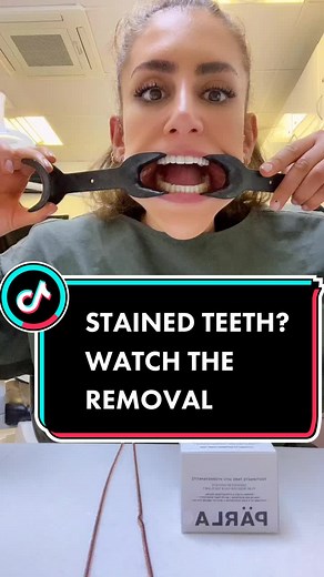 Teeth Whitening and Bonding with Parla Toothpaste Tabs