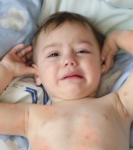 Spider Bites In Toddlers: What Parents Need To Know