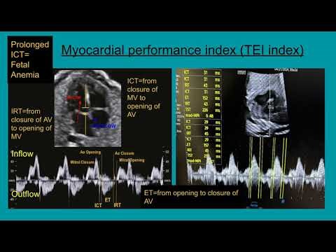 Tei Index Made Simple | How to Measure It by Ultrasound