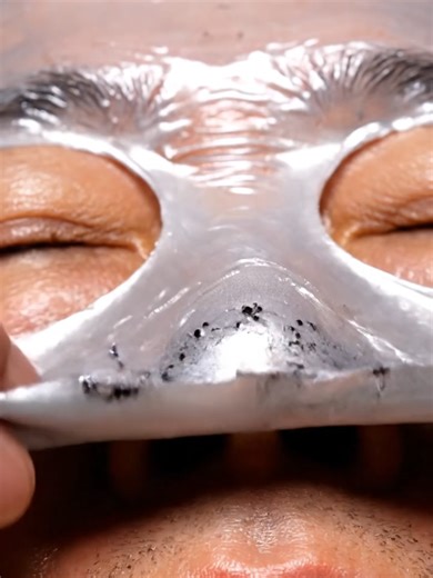 The Ultimate Blackhead Forest: Peel Off for Smooth Skin