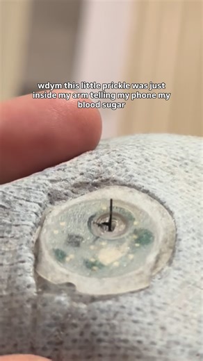 Emily Vilé on Instagram: "Ok I’m officially done with my first full Libre 3+ experience and I’ve decided to make the switch!! Pros: - The ypso algorithm seems to be working heaps better (?????? Who would have thought type of CGM would be a factor??????) - It’s literally tiny - 60 minute warm up 🤌🏽🤌🏽🤌🏽🤌🏽🤌🏽🤌🏽🤌🏽 - Reads every minute Cons: - Still don’t understand why the adhesive is so skinny - Lost the arrow quite a few times - Lasted 14 of the 15 days (kinda a pro though because tha