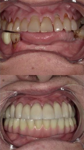 Full Mouth Smile Makover| Upper Teeth Rehab & Lower Implant-Supported Denture