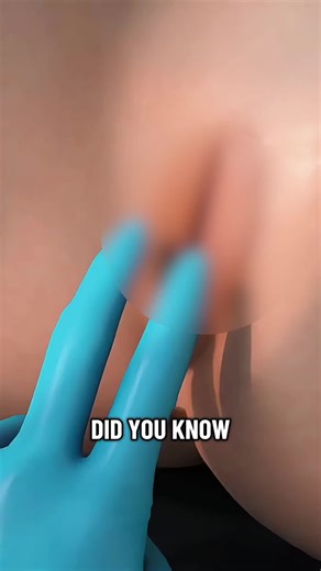 What is V-Tone Procedure and How It Works? (3D Animation) #vtonetreatment #vtonesurgery #rejuvination #tightening #musclestightening