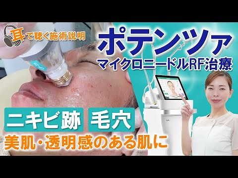 [For work] Listen to the treatment instructions! Potenza Microneedle RF Treatment: Effective for ...