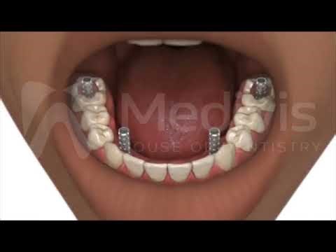All-on-4 Dental Implants | 3D Animation Full Procedure (Step-by-Step)