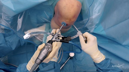Meniscal Root Repair Using the SutureLoc™ Implant