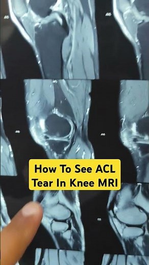 How To See ACL Tear In Knee MRI.. Dr Sai Chandra