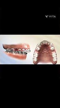 Overjet Treatment .Your Smile Our's Priority. #dentist #teeth #orthodontist