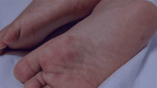 Hand, foot and mouth disease is spreading in Green Bay schools. Here's what to know