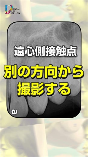 [What knowledge should you know about normal dental images (Canine teeth edition) (Maxillary cani...