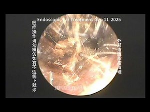 Cleaning of External Auditory Canal Cholesteatoma 20250911