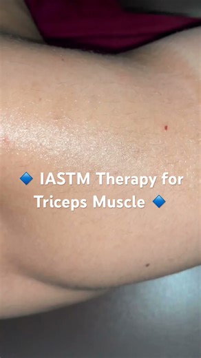 IASTM Therapy for Triceps Muscle | Instrument Assisted Soft Tissue Mobilization | Physiotherapy
