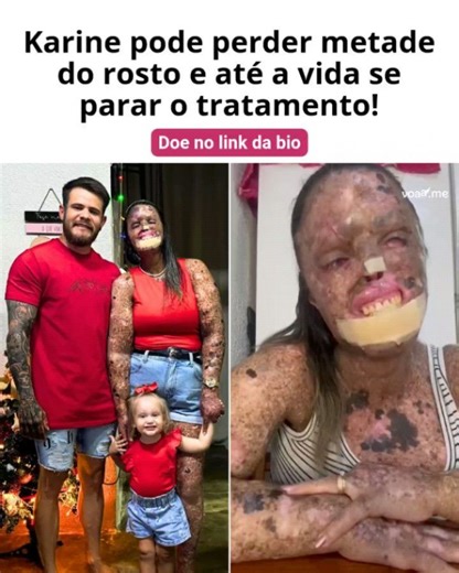 Razões Para Acreditar on Instagram: "A Kah tem uma doença rara chamada Xeroderma Pigmentoso, que faz sua pele não ter defesa contra o sol, e as lesões que aparecem evoluem para cânceres agressivos. São muitos anos de tratamentos e cirurgias sem fim. E ela tem vivido o que parecia impossível: graças à vaquinha anterior, ela iniciou a Imunoterapia, e as lesões que tomavam seu rosto desapareceram e as do corpo também estão melhorando. Até a cirurgia que tiraria metade de sua face foi cancelada. Ma