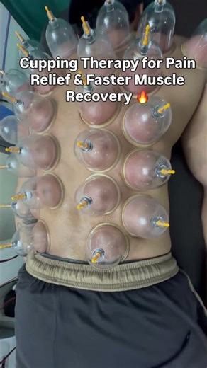 Cupping Therapy for Pain Relief & Faster Muscle Recovery 🔥