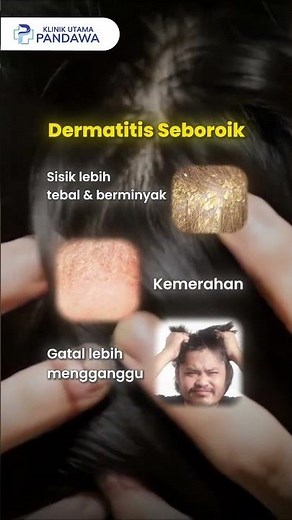 Dandruff Won't Go Away? It Could Be Seborrheic Dermatitis!