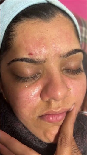 How to remove blackheads with face stem #song #salonlife