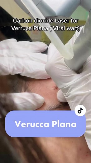 Carbon dioxide Laser for Verruca Plana ( Viral wart ). Book your appointments today! 🙌🏻 #fyp #foryoupage #skin #laser #treatment #viral